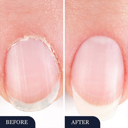 Pero na ošetrenie nechtovej plesne na poškodené nechty